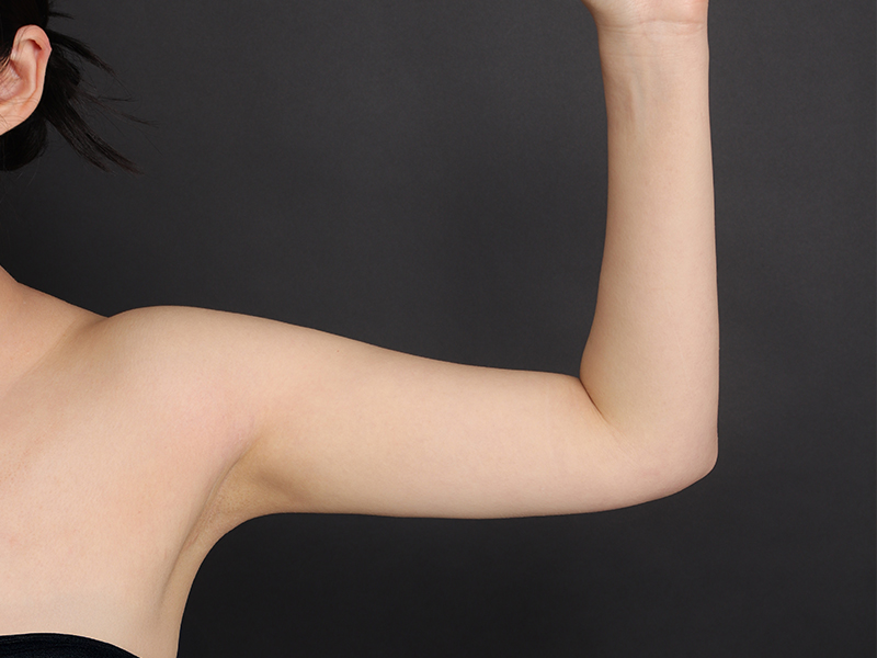 Arm liposuction after