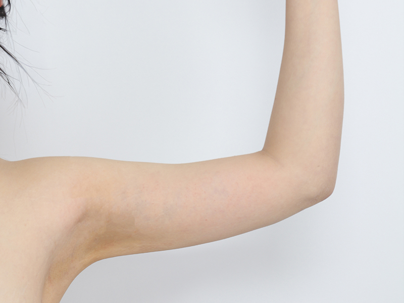 Arm liposuction after