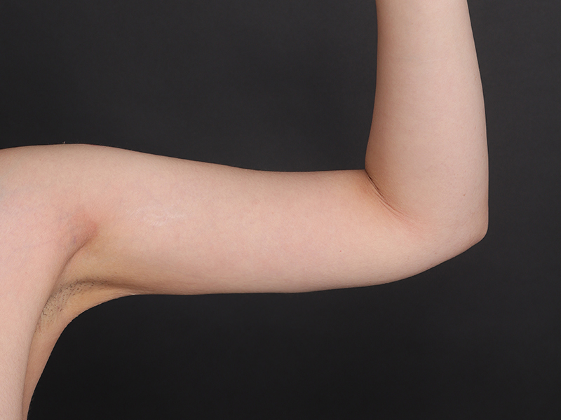 Arm liposuction after