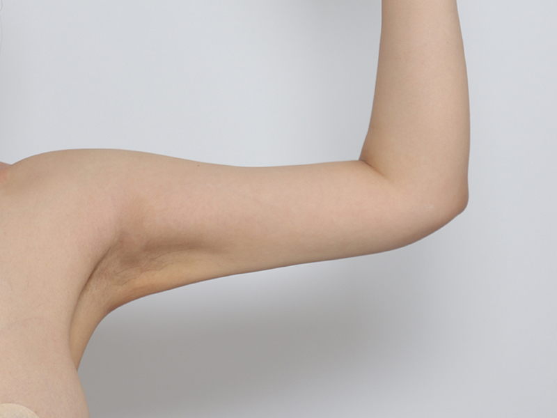 Arm liposuction after