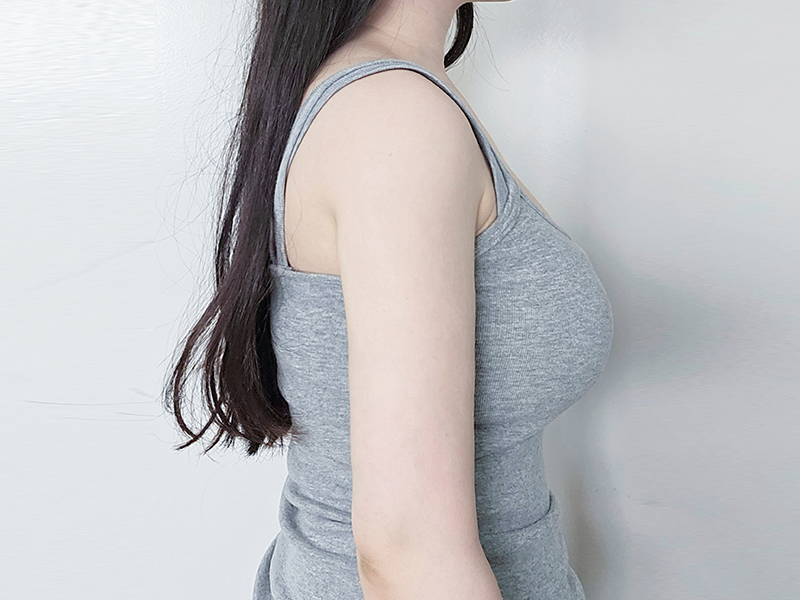 Arm liposuction after