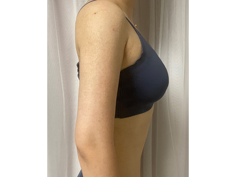 Arm liposuction after
