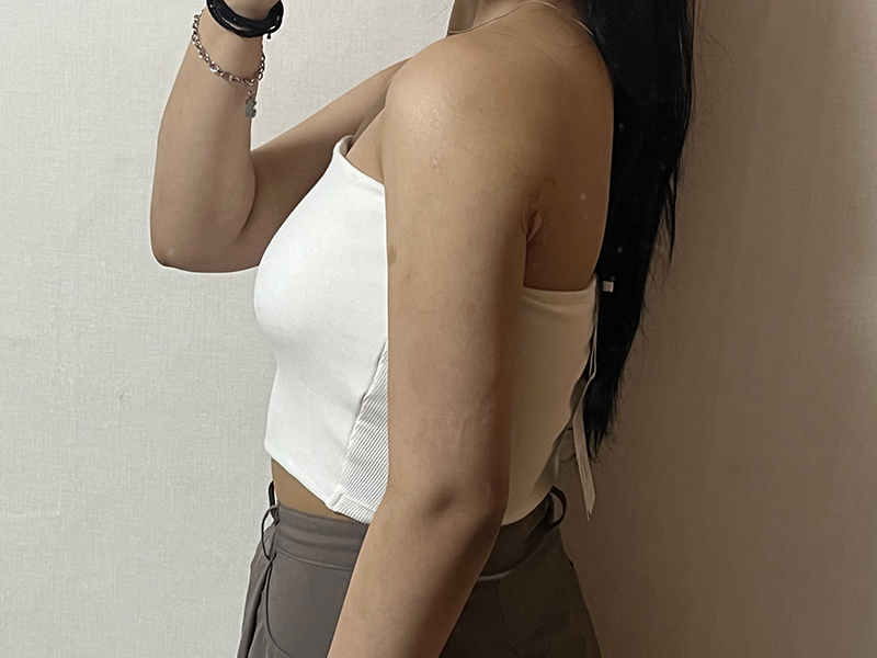 Arm liposuction after