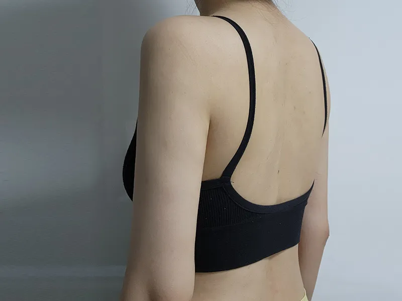 Arm liposuction after