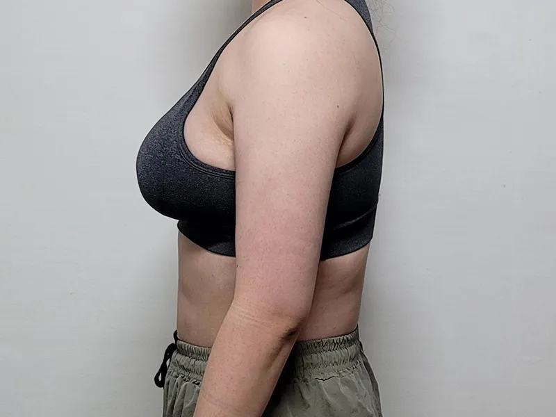 Arm liposuction after