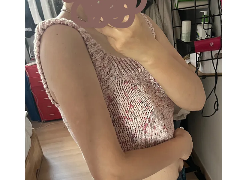 Arm liposuction after