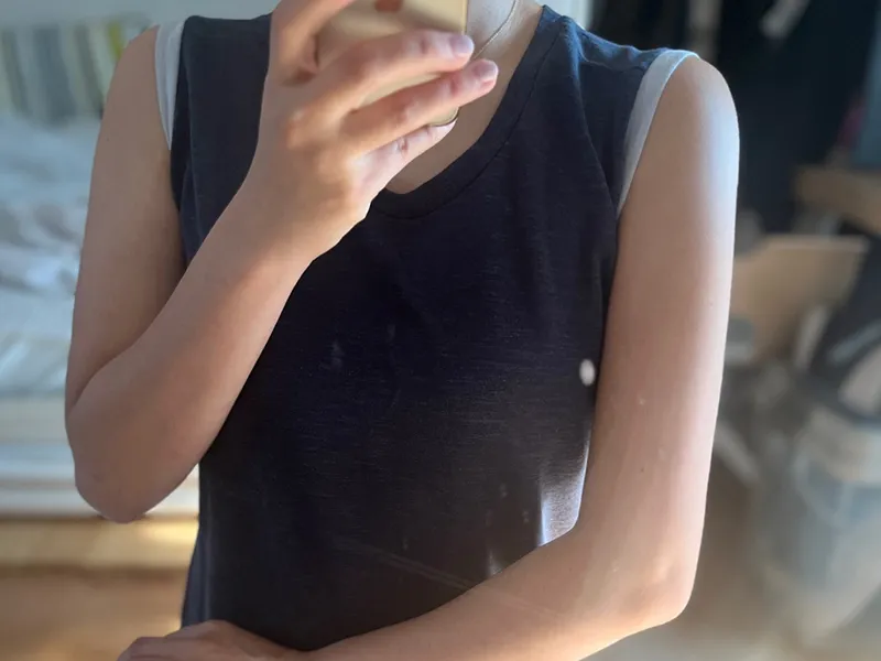 Arm liposuction after