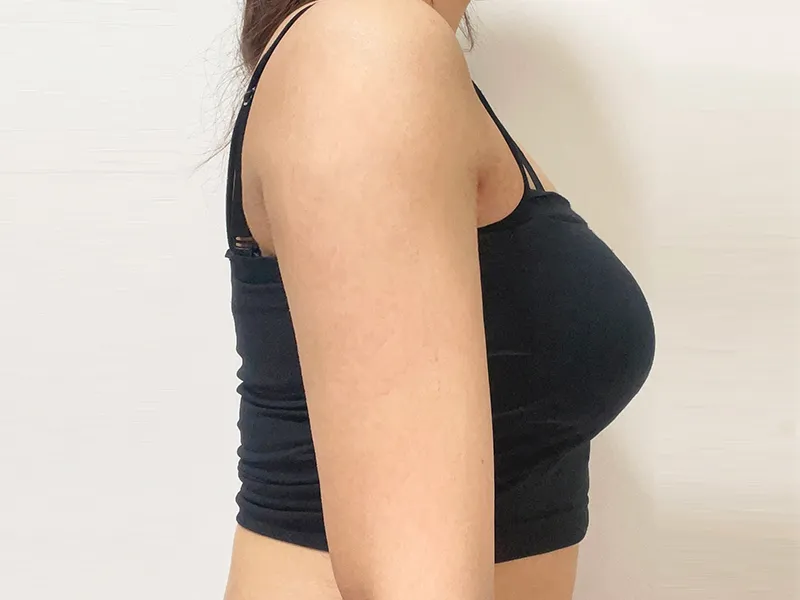 Arm liposuction after
