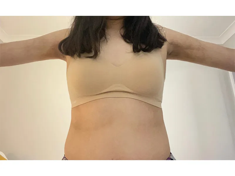 Arm liposuction after