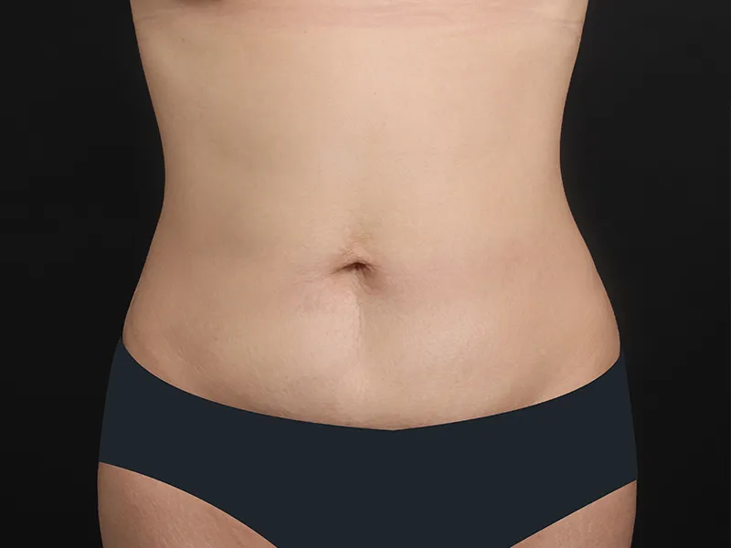 Abdomen liposuction after