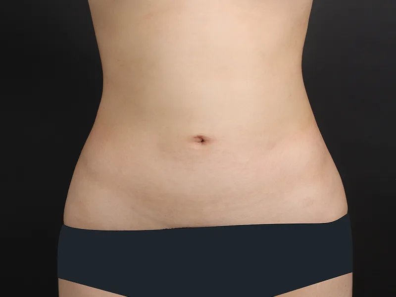 Abdomen after