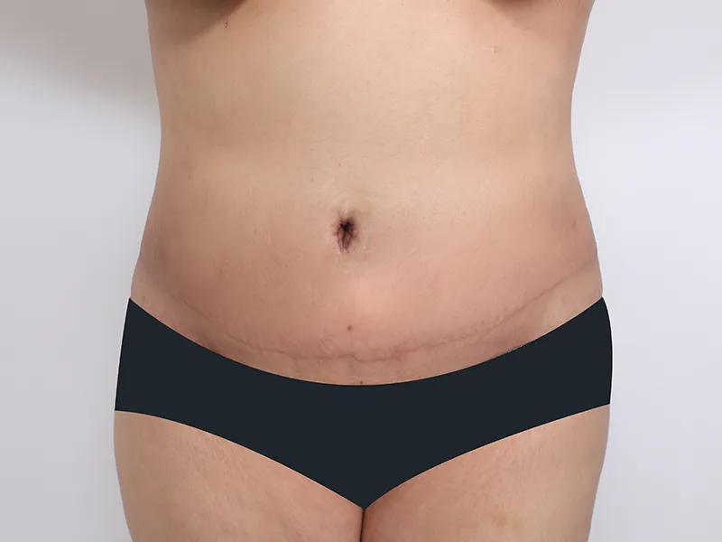 Tummy tuck after