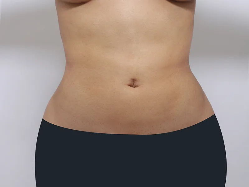 Abdomen liposuction after