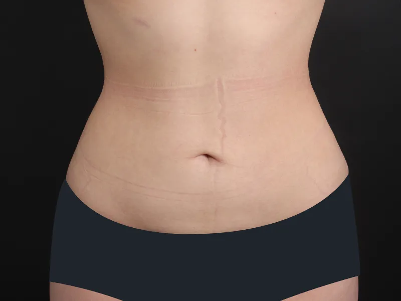 Abdomen liposuction after