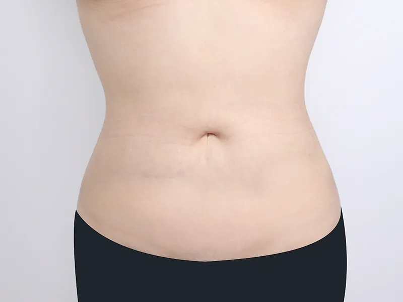 Abdomen liposuction after