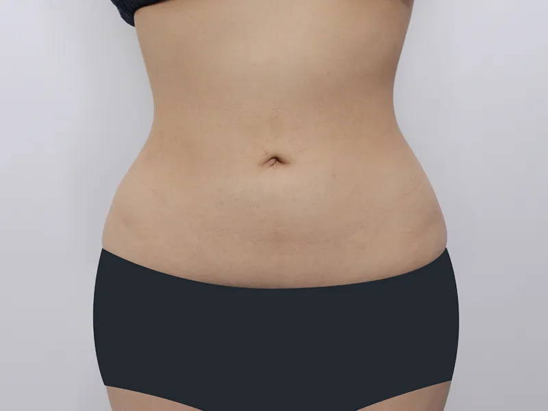 Abdomen liposuction after