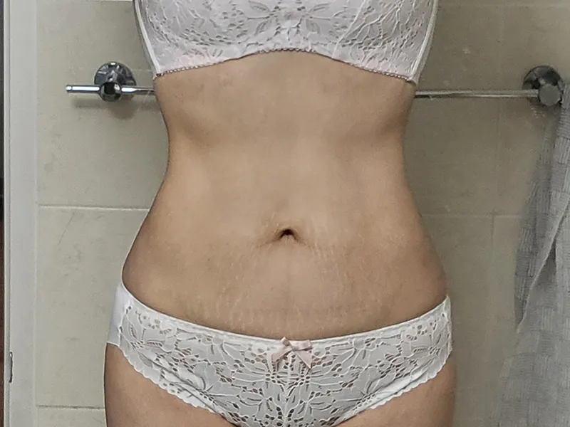 Abdomen liposuction after