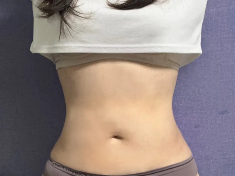 Abdomen liposuction after