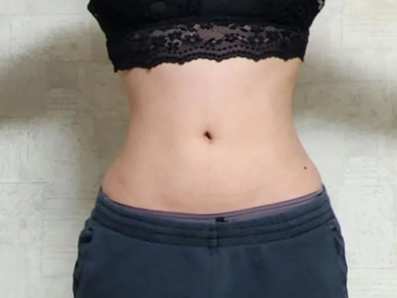 Abdomen liposuction after