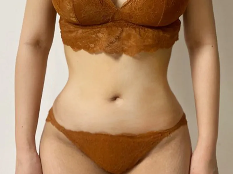 Abdomen liposuction after