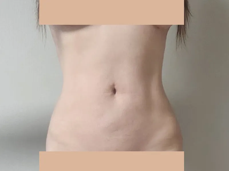 Abdomen liposuction after