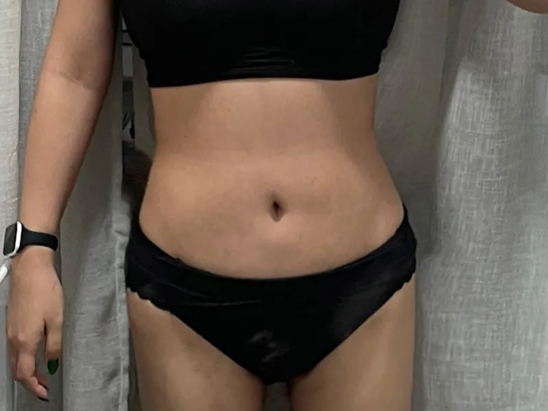 Abdomen liposuction after