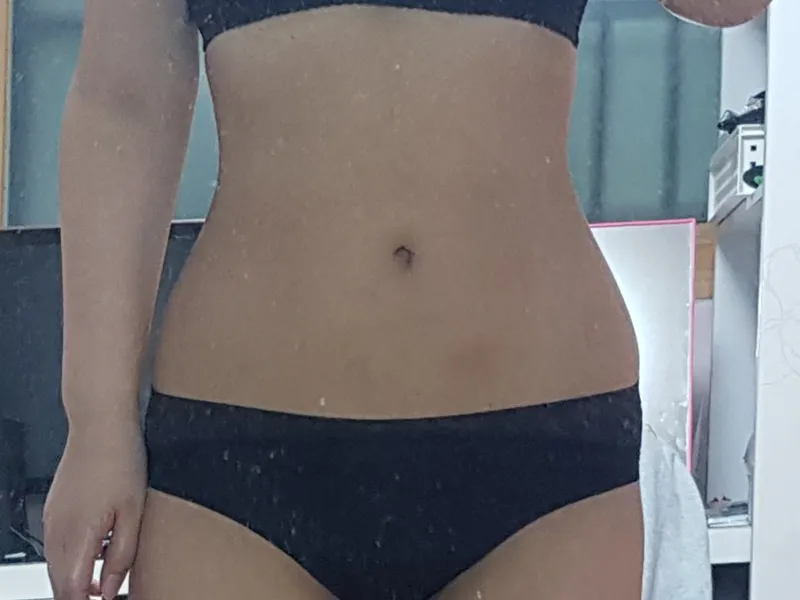 Abdomen liposuction after
