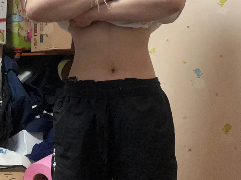 Abdomen liposuction after