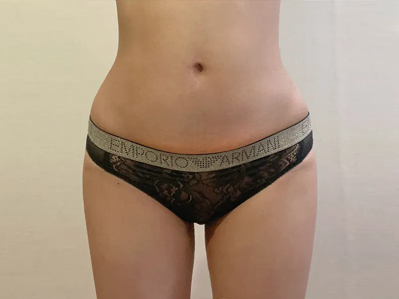 Abdomen liposuction after