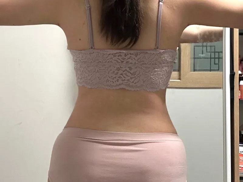 Abdomen liposuction after