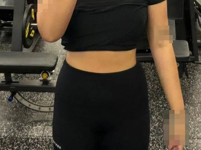 Abdomen liposuction after