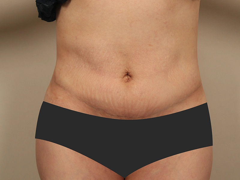 Tummy tuck after
