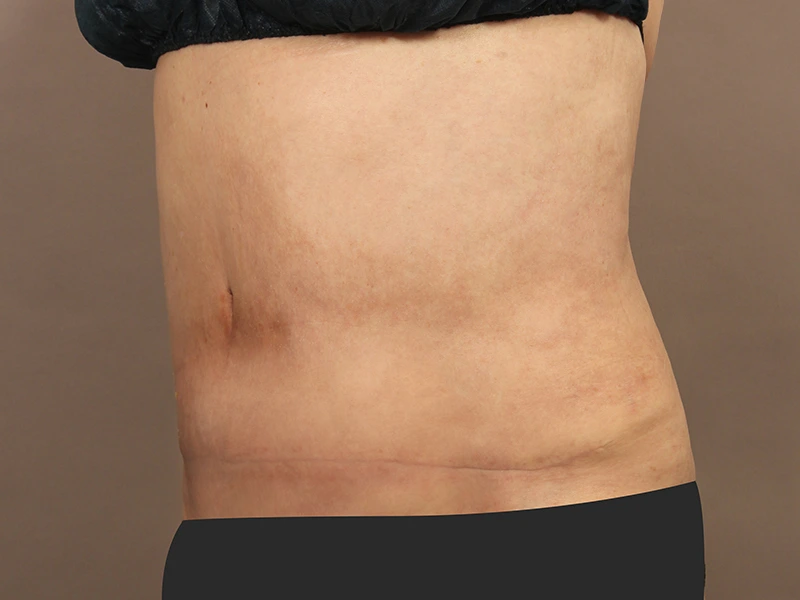 Tummy tuck after
