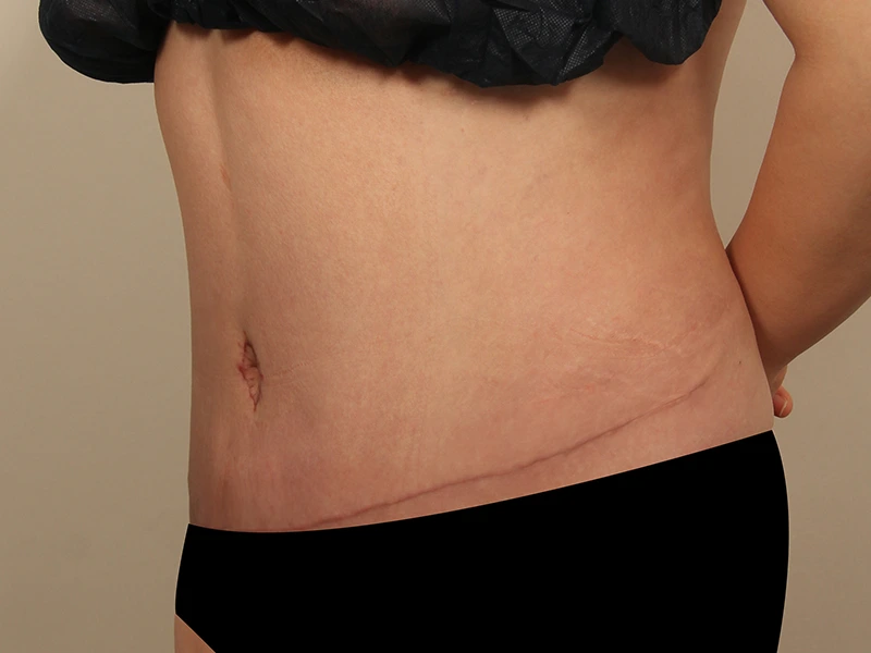 Tummy tuck after