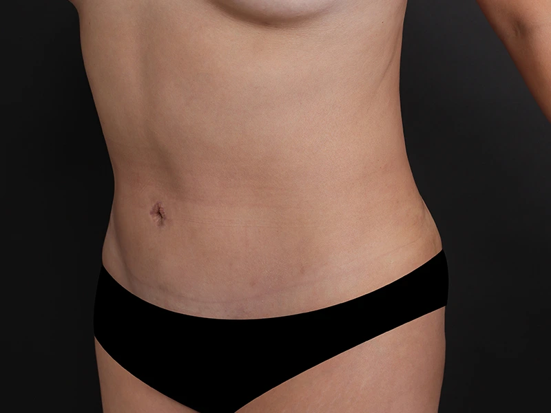 Tummy tuck after