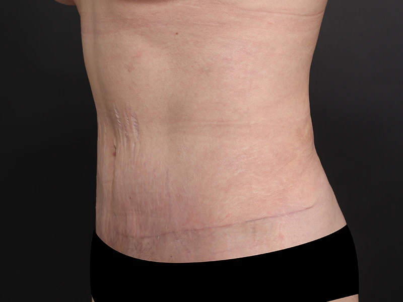 Tummy tuck after