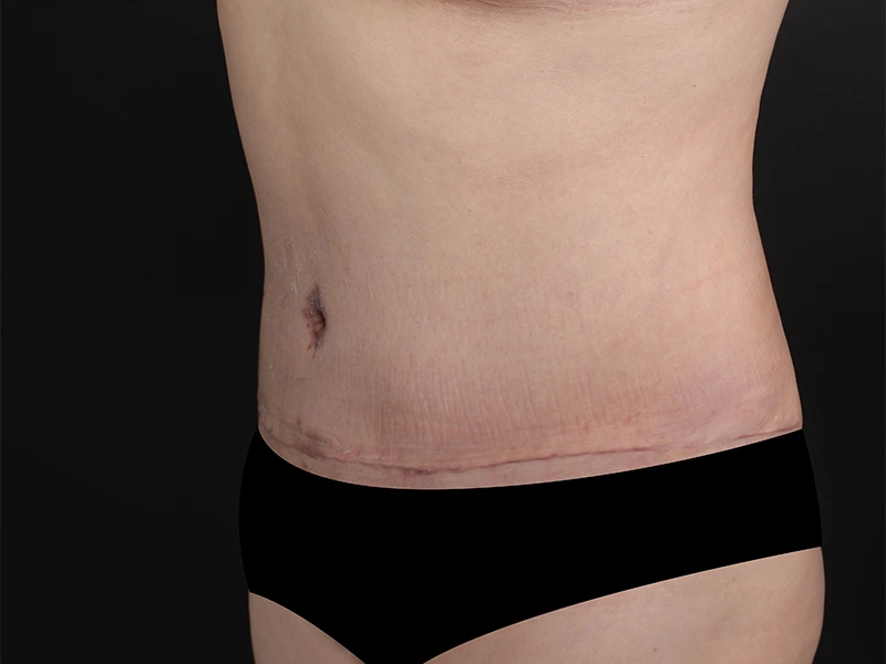 Tummy tuck after