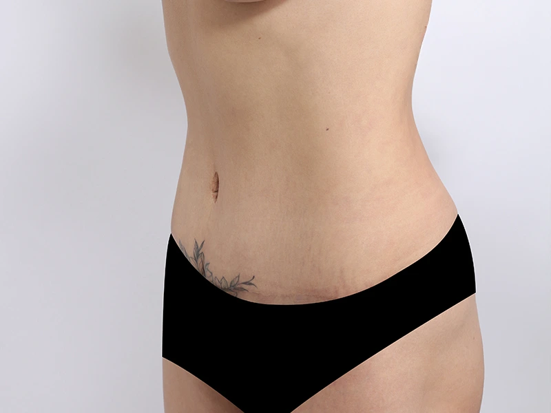 Tummy tuck after