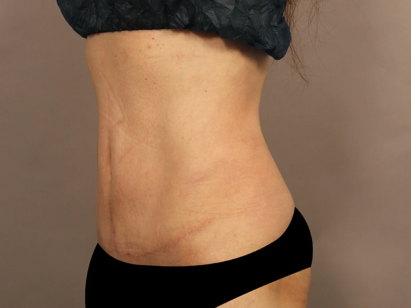 Tummy tuck after
