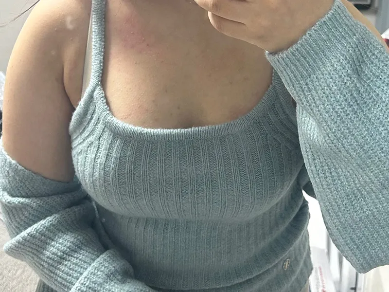 Breast fat transfer after