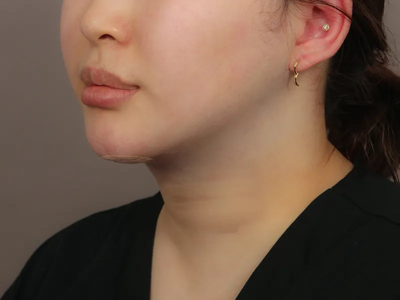 Face liposuction after