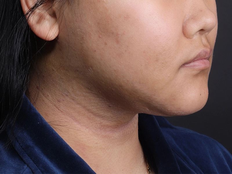 Face liposuction after