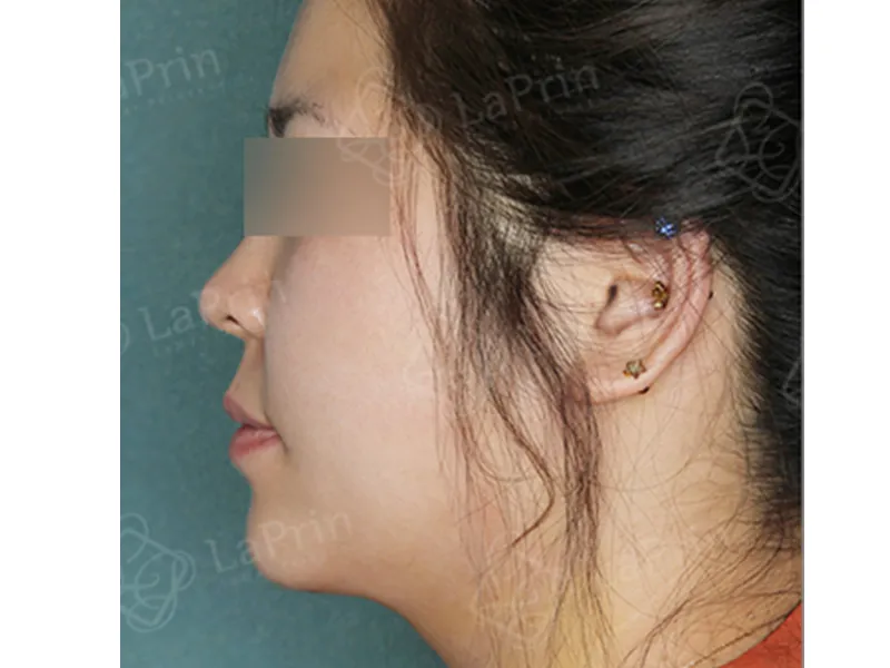 Face liposuction after