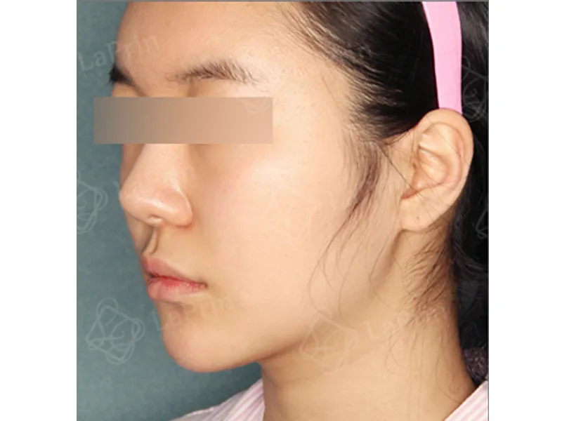 Face liposuction after
