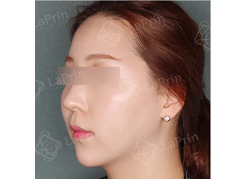 Face liposuction after