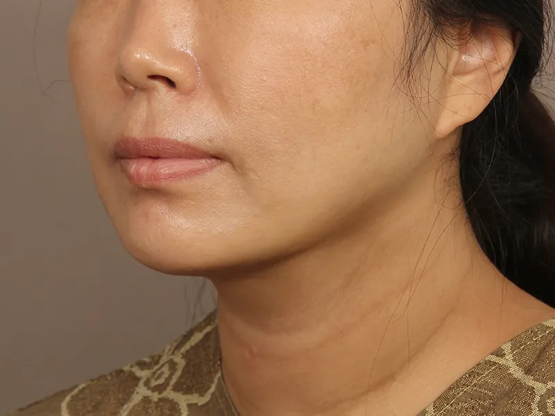 Face liposuction after