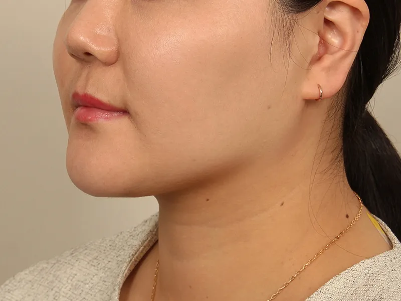 Face liposuction after