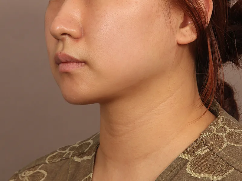 Face liposuction after