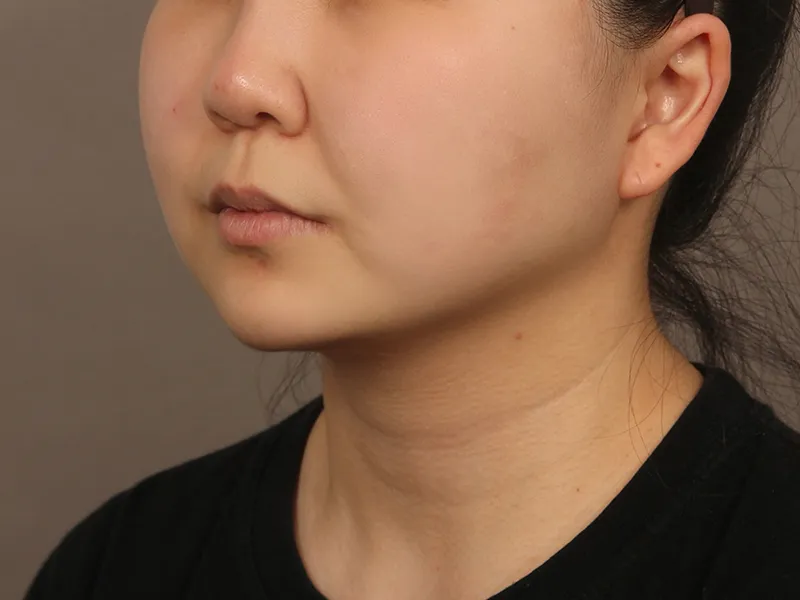 Face liposuction after
