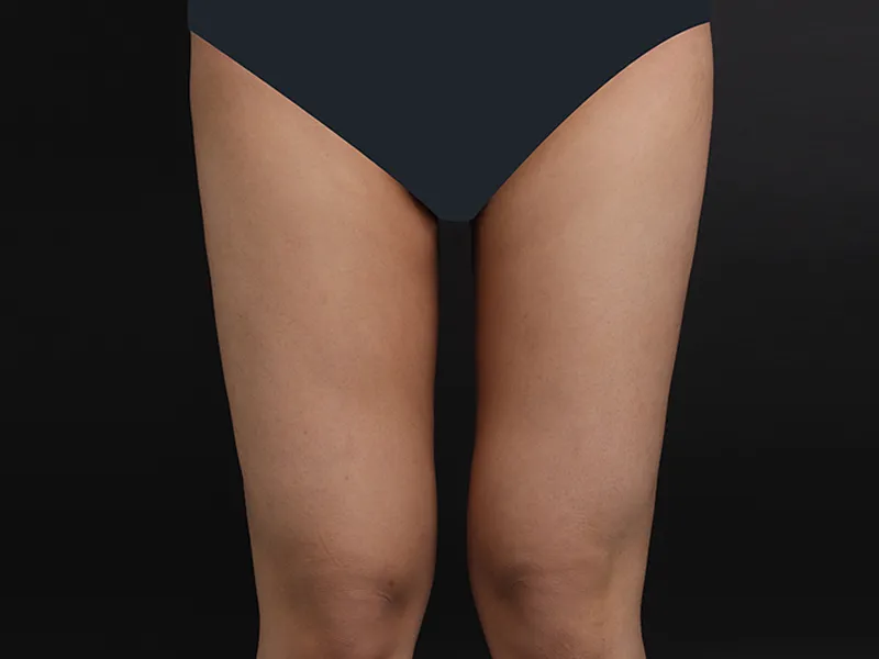 Thigh liposuction after